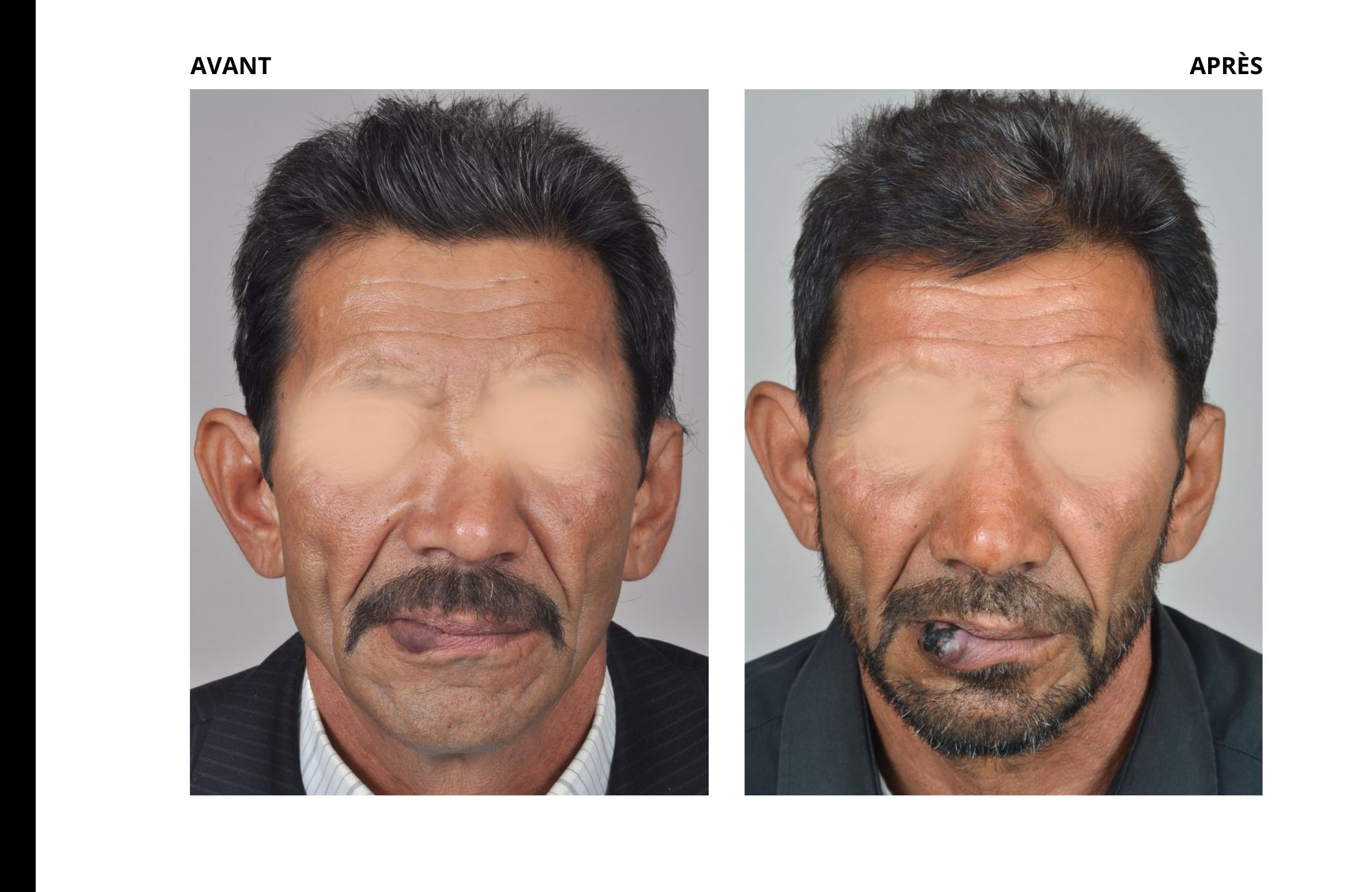 cas rhinoplastie déviation cloison nasale