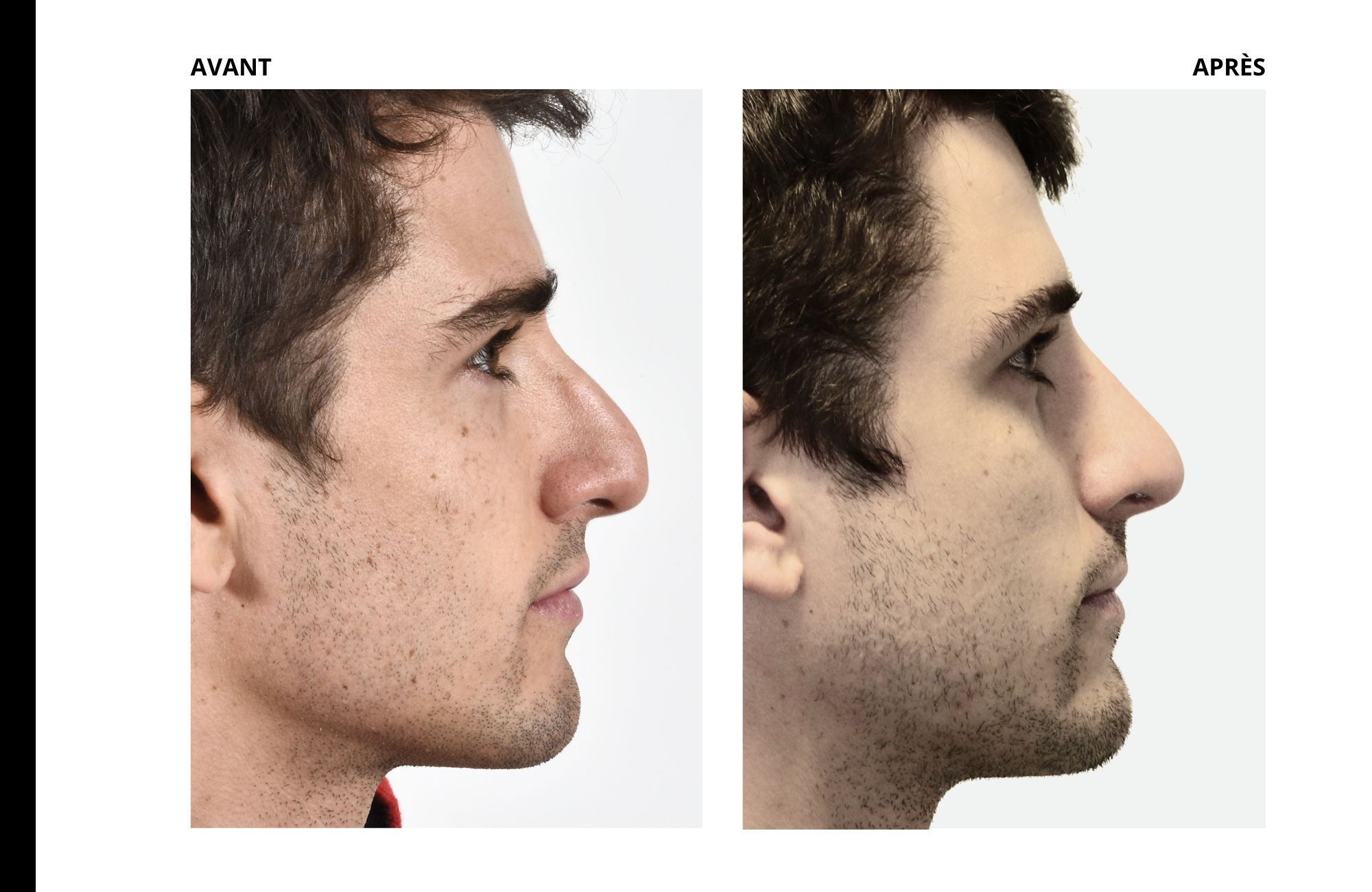 cas rhinoplastie