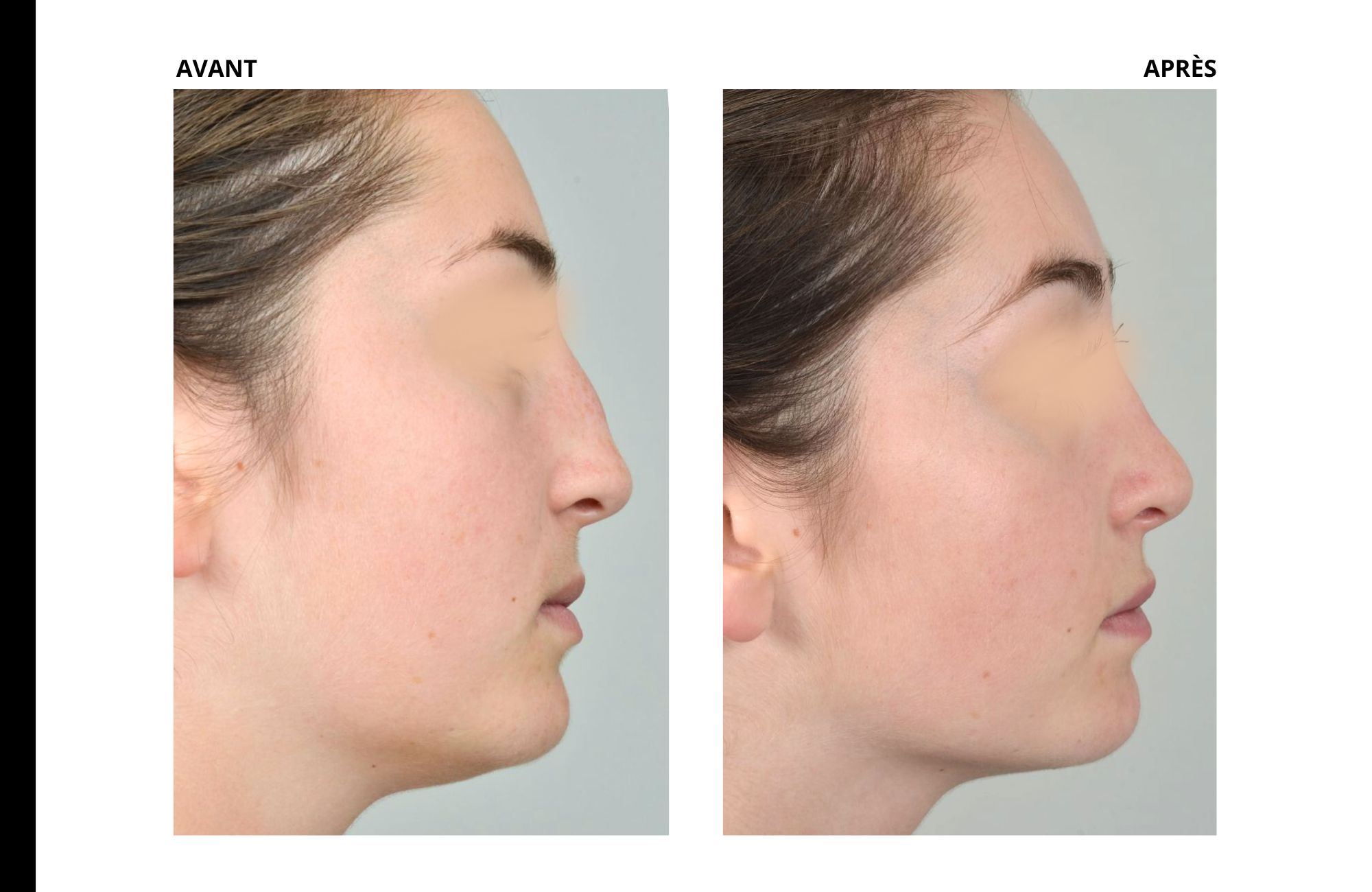 cas rhinoplastie