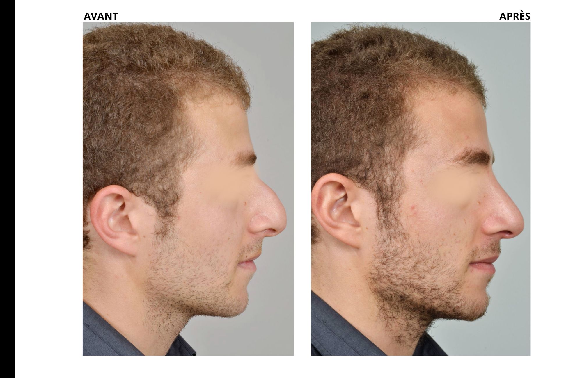 cas rhinoplastie