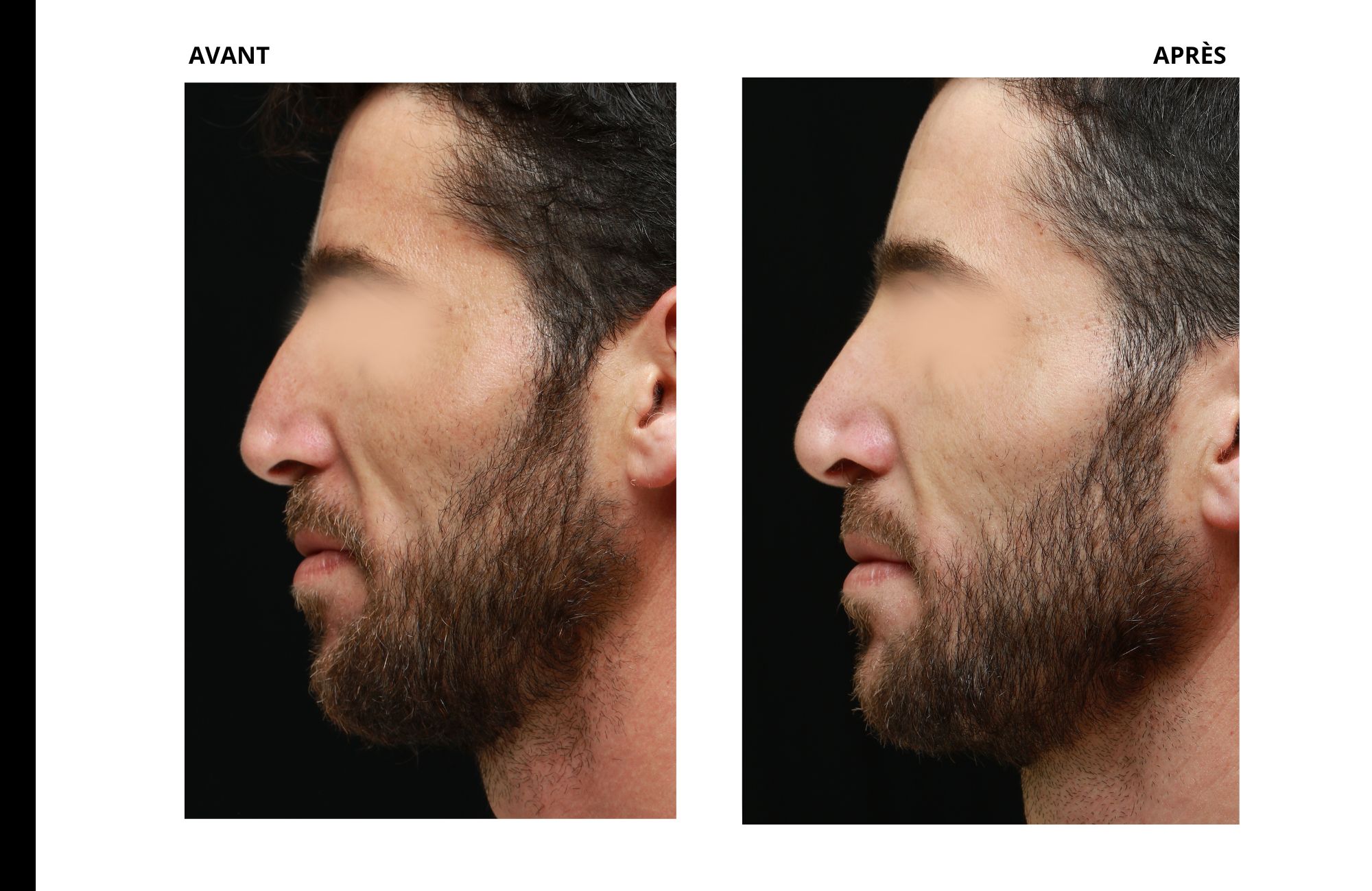 cas rhinoplastie