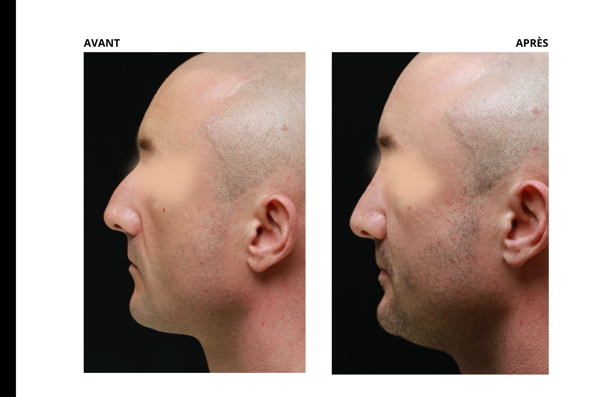 cas rhinoplastie