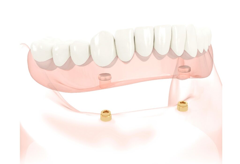 Implants multiples