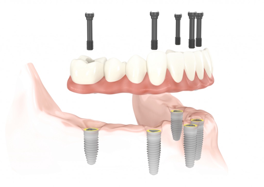 implants multiple All on 4 1024x726 1